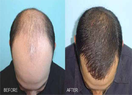 Grab your seat for the Best Hair Fall Treatment Restoration Techniques Available only at  Looks Enhance  Hair Clinic.